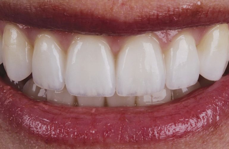 Ολική αποκατάσταση Στόματος