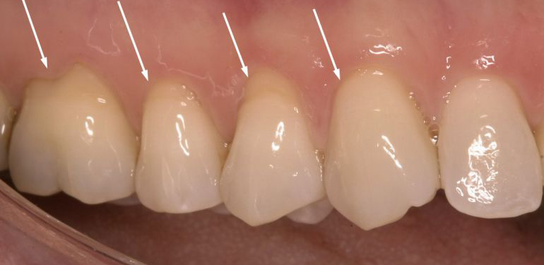 ΥΦΙΖΗΣΗ-ΠΤΩΣΗ ΤΩΝ ΟΥΛΩΝ ΑΙΤΙΕΣ ΚΑΙ ΘΕΡΑΠΕΙΑ