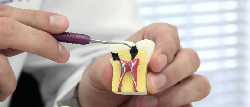 Ενδοδοντία