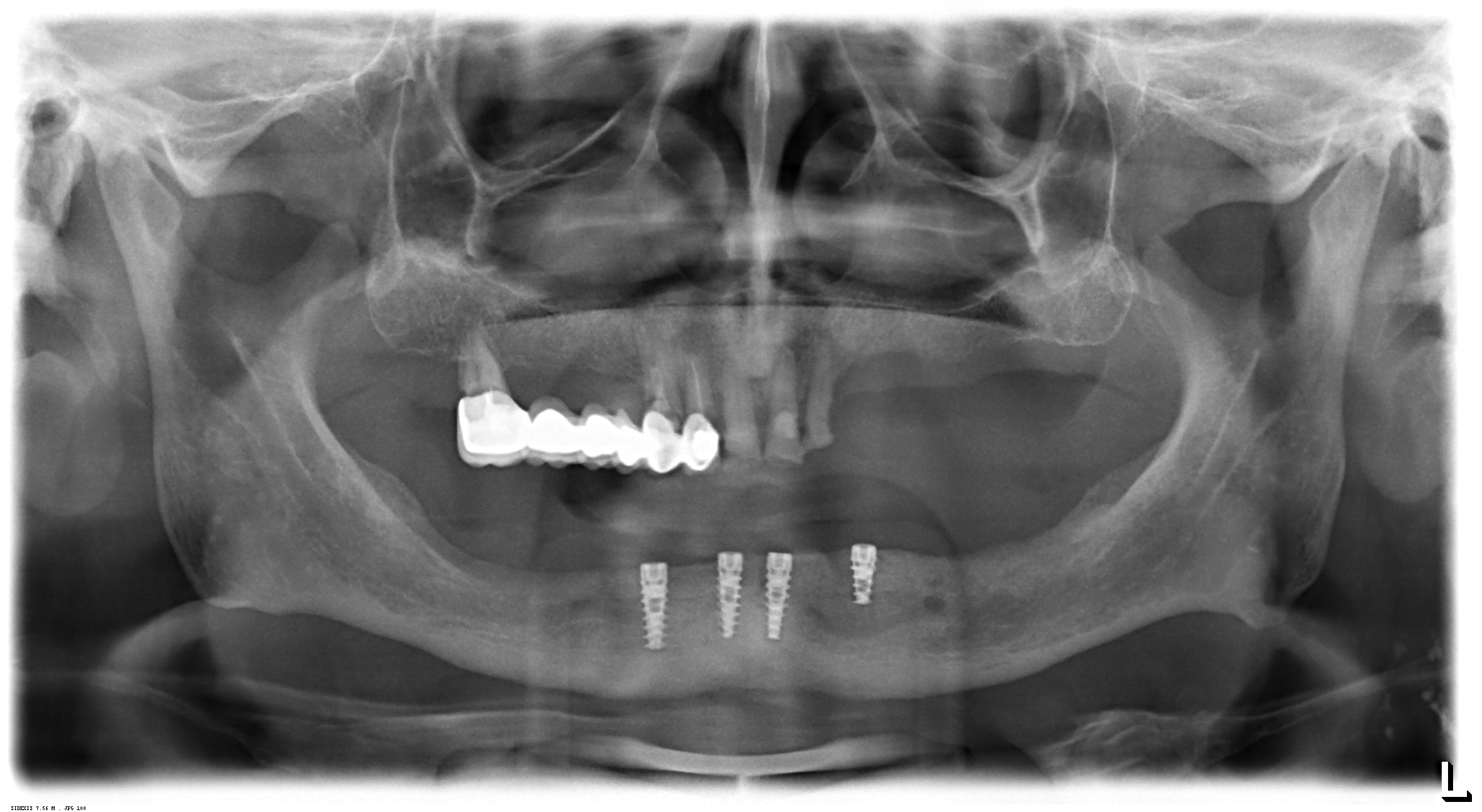 Ψηφιακή Ακτινογραφία
